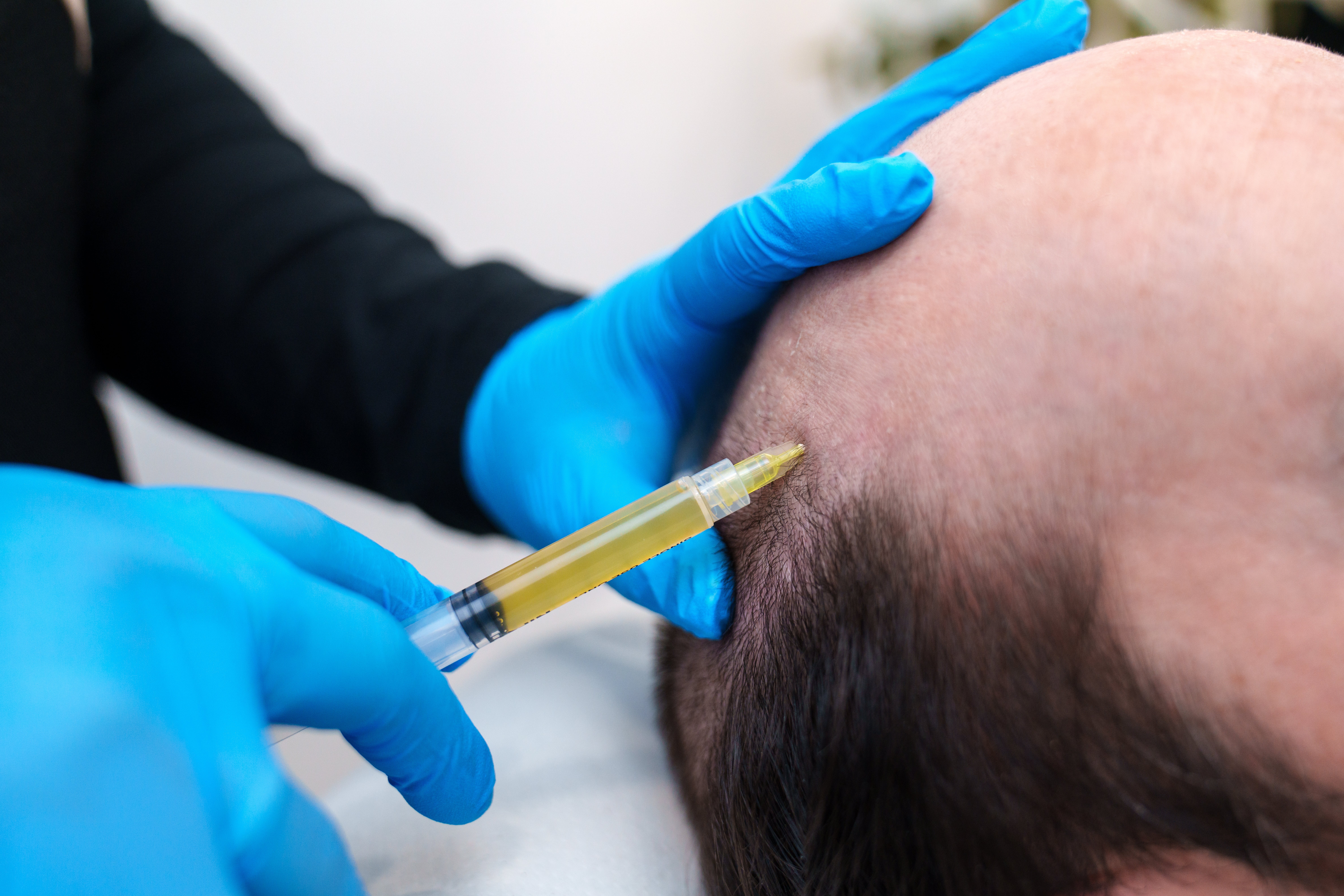 En person i blå handskar applicerar en medicinsk behandling på en mans hårbotten med en spruta.