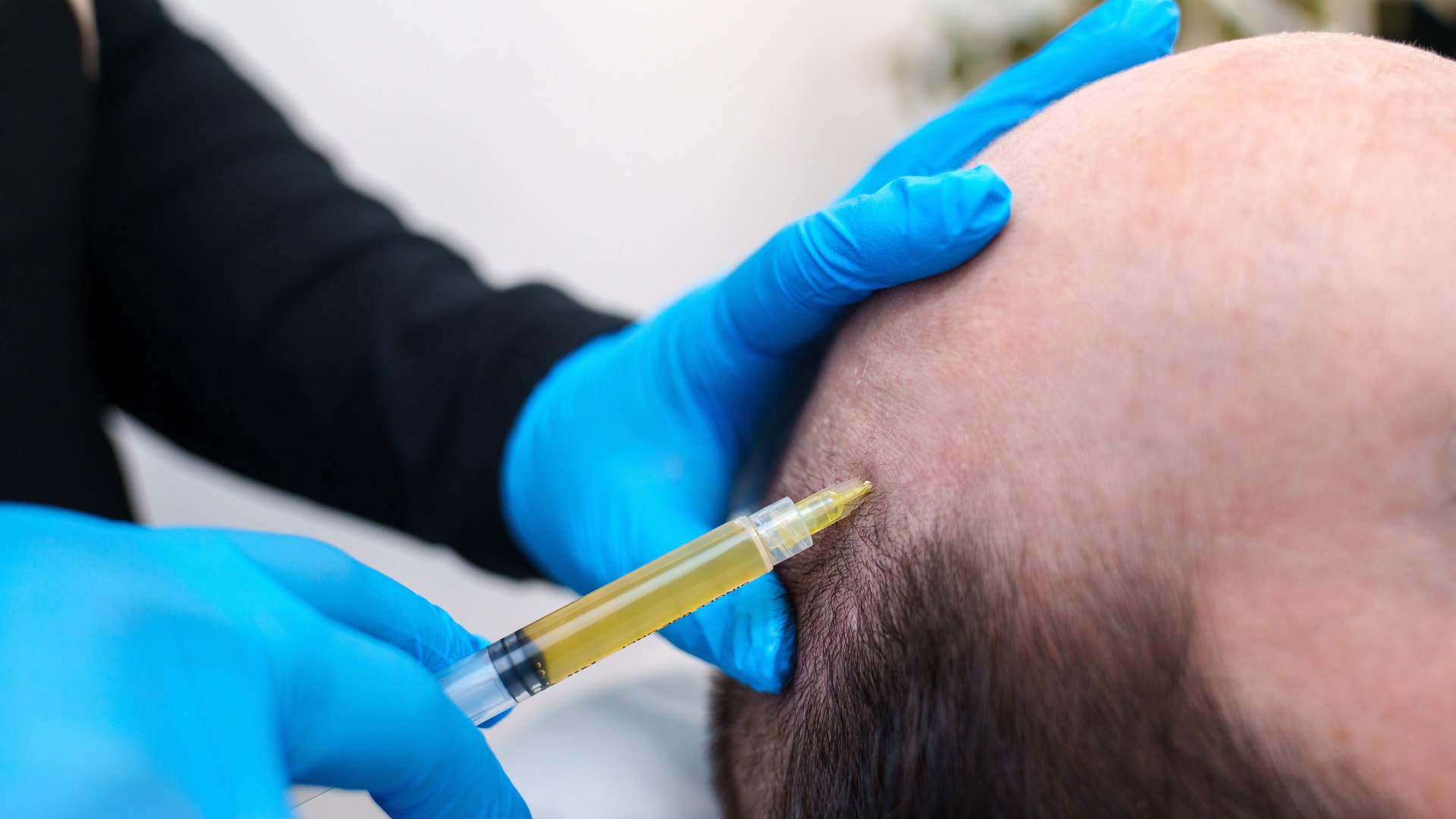 En person i blå handskar applicerar en medicinsk behandling på en mans hårbotten med en spruta.
